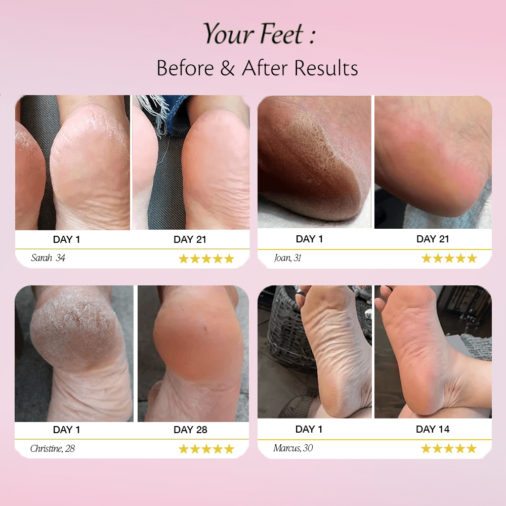 Solevia™ Electric Foot Callus Remover