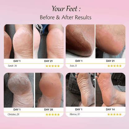 Solevia™ Electric Foot Callus Remover